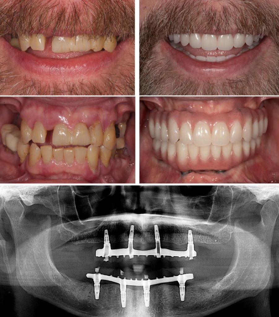 All On Four Dental Implants in Houston Texas